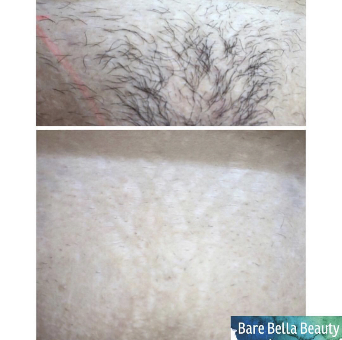My laser hair removal did not work – Barebella Beauty