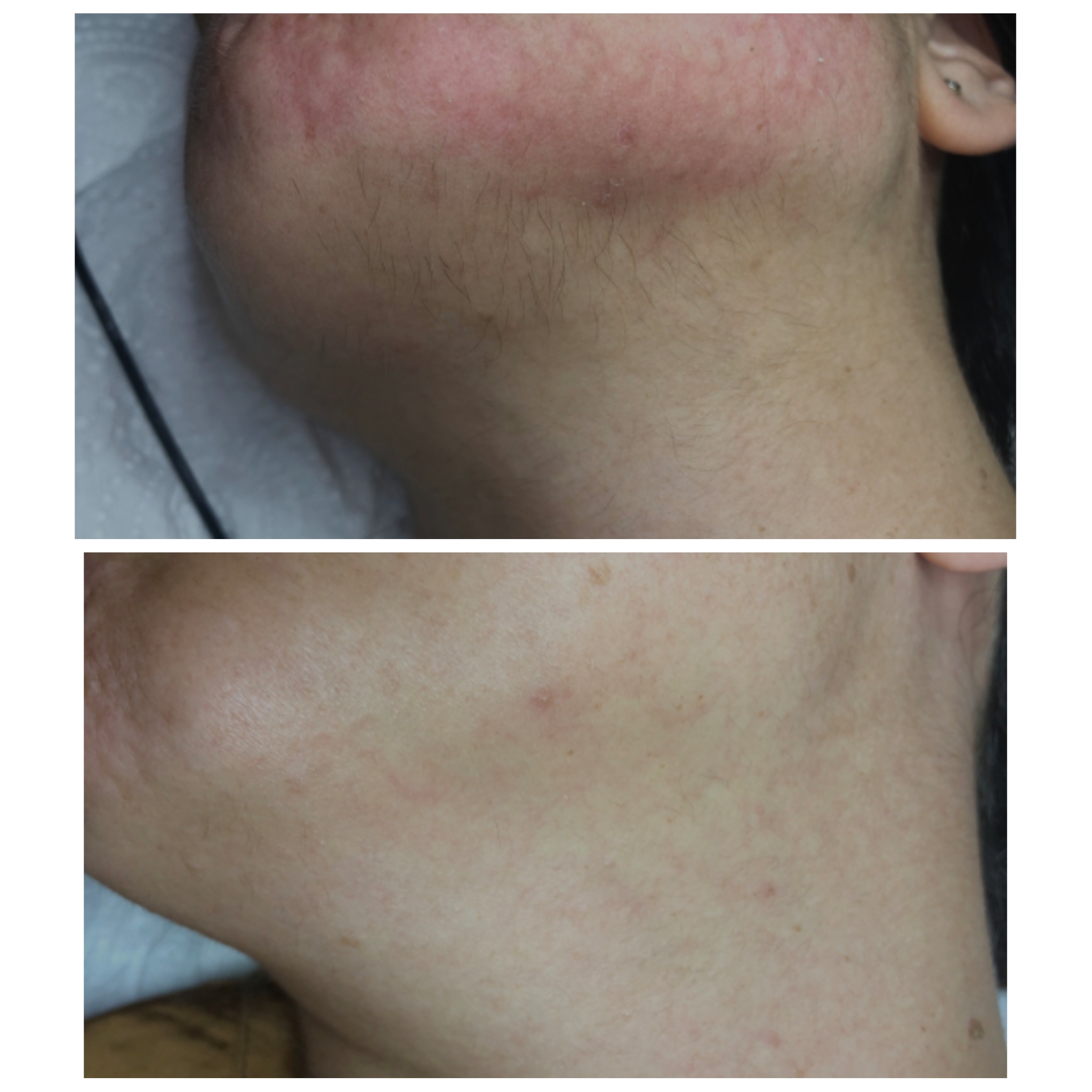 Finished laser treatment, what to do with the hair after laser is finished.  – Barebella Beauty