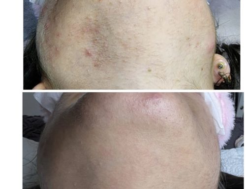 Hormones and permanent hair removal