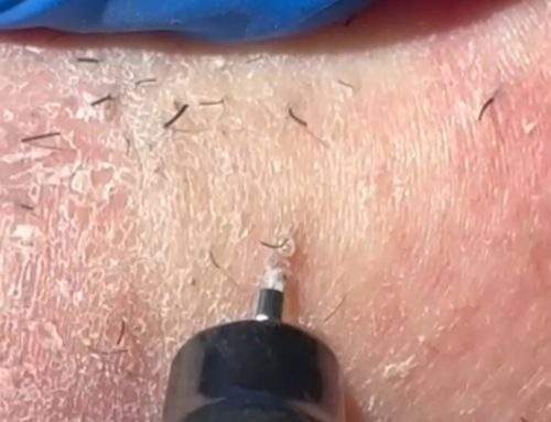 Can you trim hair inbetween electrolysis treatments?