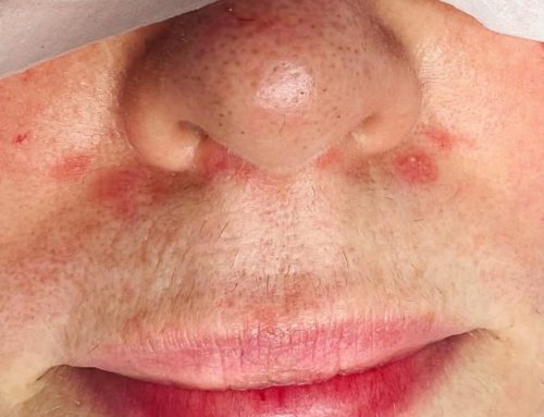 What to do when you find out you have perioral dermatitis.