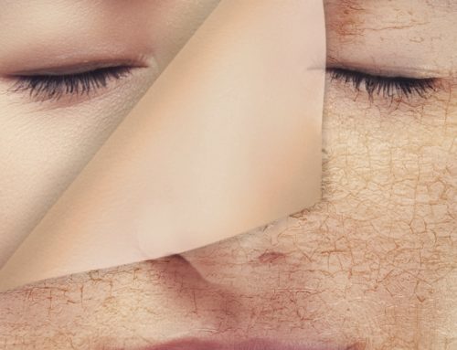 What is a chemical peel?